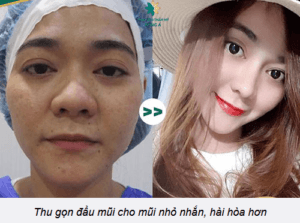 Thu nhỏ cánh mũi