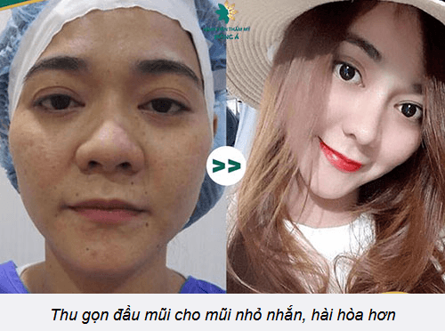 Thu nhỏ cánh mũi