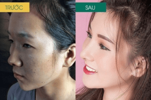 Thu nhỏ cánh mũi