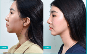 Phẫu thuật xóa gồ mũi