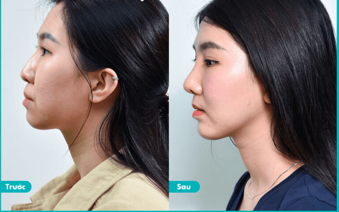 Phẫu thuật xóa gồ mũi
