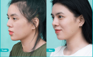Phẫu thuật xóa gồ mũi