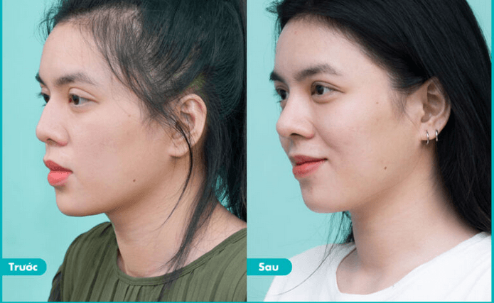Phẫu thuật xóa gồ mũi