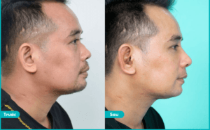Phẫu thuật xóa gồ mũi