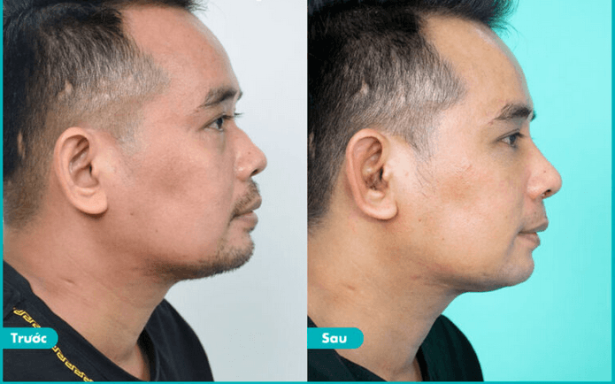 Phẫu thuật xóa gồ mũi