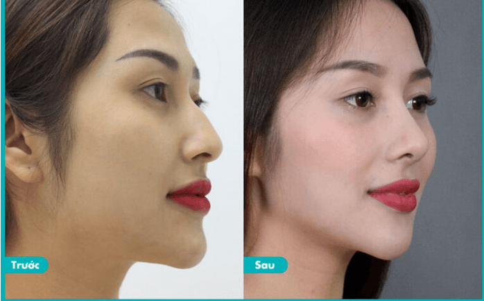Phẫu thuật xóa gồ mũi