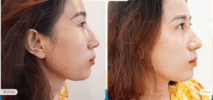 Phẫu thuật xóa gồ mũi