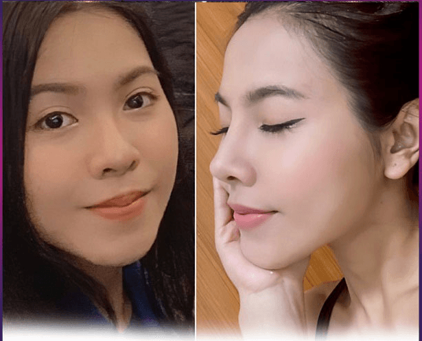 Nâng mũi chỉ