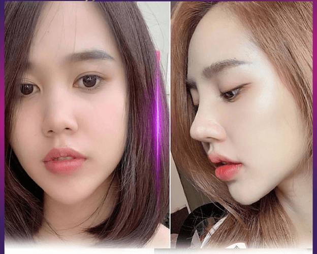 Nâng mũi chỉ