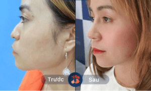 Sửa mũi lỗi do tai nạn hoặc phẫu thuật