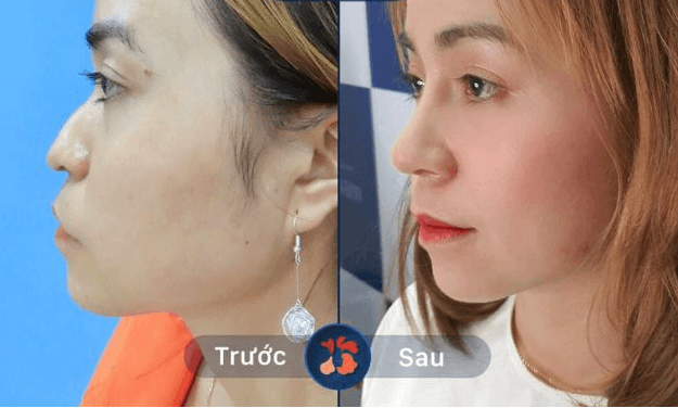 Sửa mũi lỗi do tai nạn hoặc phẫu thuật
