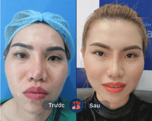 Sửa mũi lỗi do tai nạn hoặc phẫu thuật