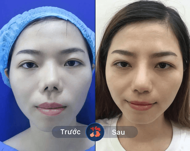 Sửa mũi lỗi do tai nạn hoặc phẫu thuật