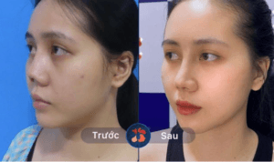 Sửa mũi lỗi do tai nạn hoặc phẫu thuật