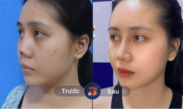 Sửa mũi lỗi do tai nạn hoặc phẫu thuật