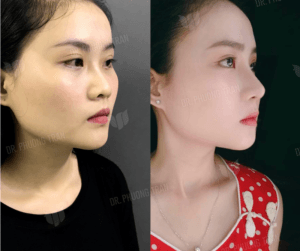 Nâng mũi sụn
