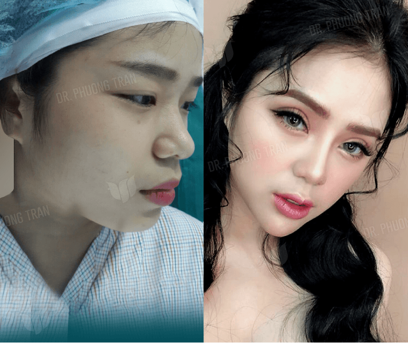 Nâng mũi sụn