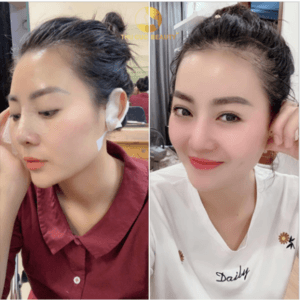 Nâng mũi sụn