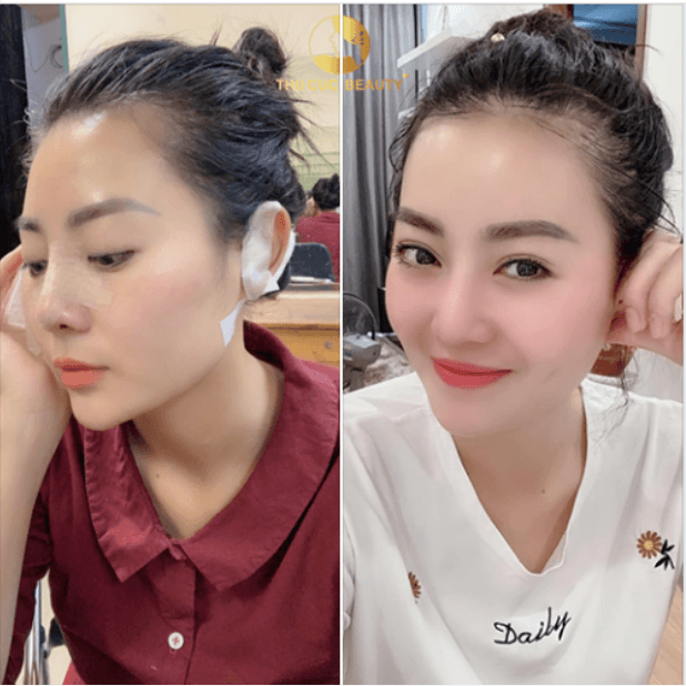 Nâng mũi sụn