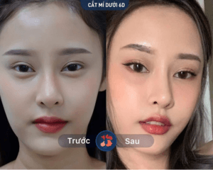 Bóc mỡ mí mắt dưới
