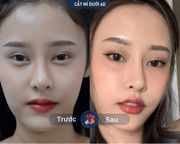 Bóc mỡ mí mắt dưới