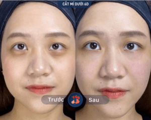 Bóc mỡ mí mắt dưới