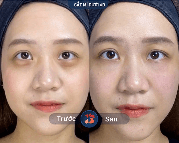 Bóc mỡ mí mắt dưới