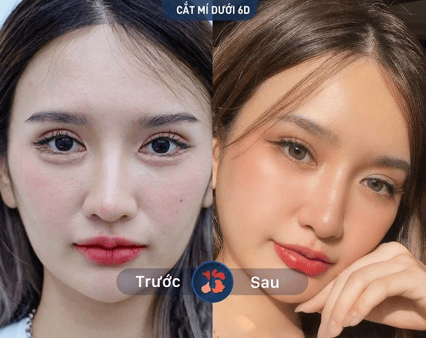 Bóc mỡ mí mắt dưới