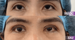Bóc mỡ mí mắt dưới