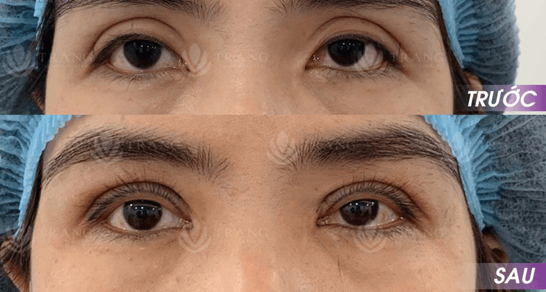 Bóc mỡ mí mắt dưới