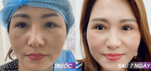 Bóc mỡ mí mắt dưới