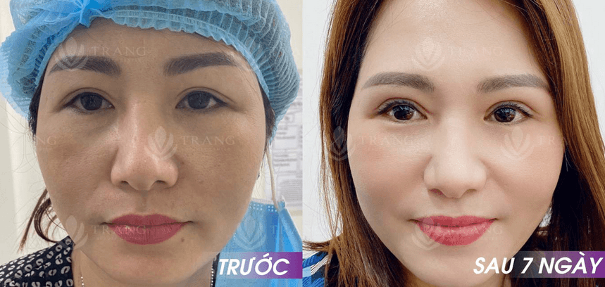 Bóc mỡ mí mắt dưới