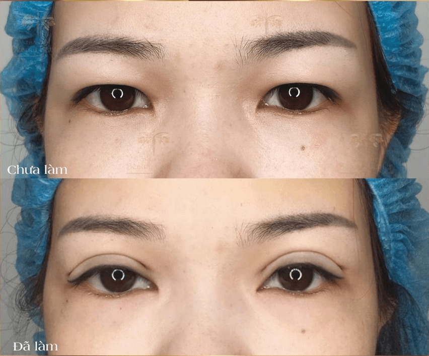 Lấy mỡ mí mắt trên