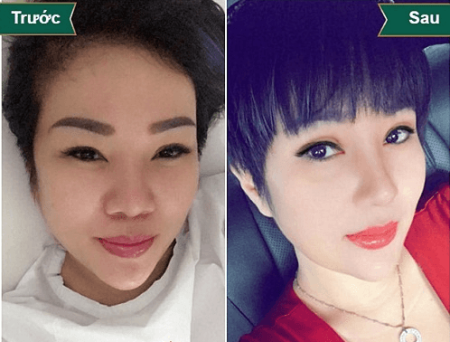 Thu Nhỏ Đầu Mũi