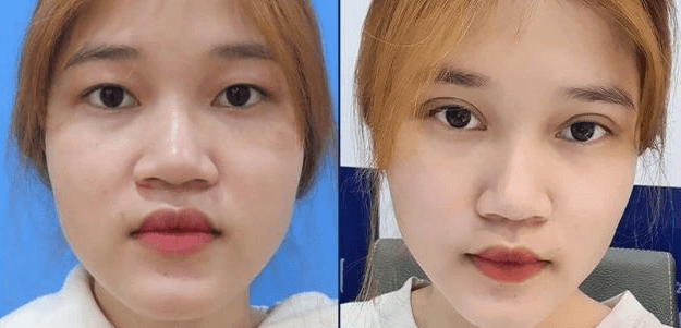 Thu Nhỏ Đầu Mũi