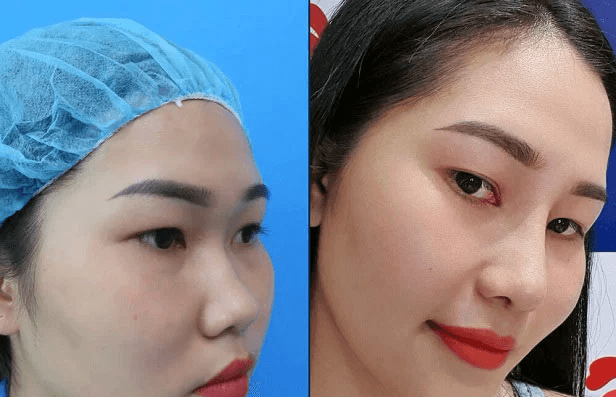Thu Nhỏ Đầu Mũi