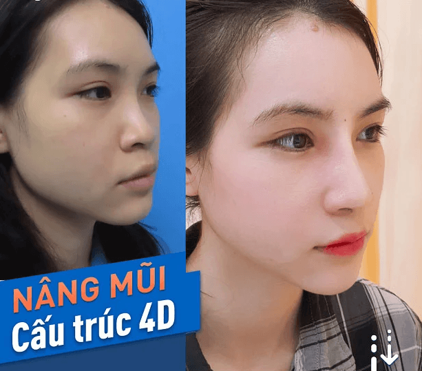 Thu Nhỏ Đầu Mũi