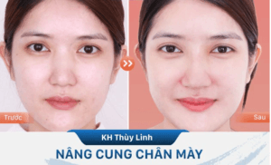 Nâng cung mày