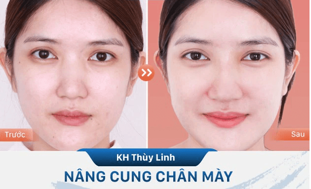 Nâng cung mày