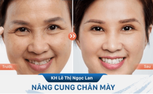 Nâng cung mày