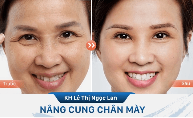 Nâng cung mày