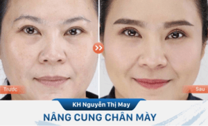 Nâng cung mày