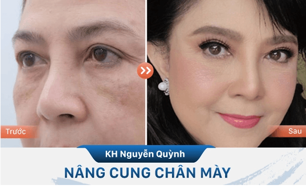 Nâng cung mày