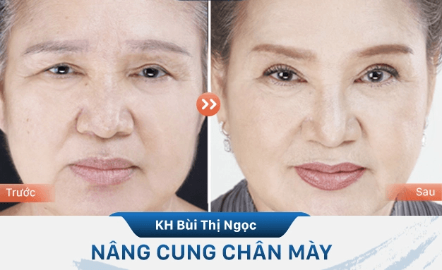 Nâng cung mày