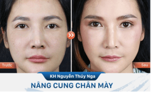 Nâng cung mày