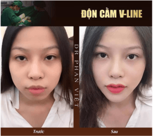 Thẩm mỹ cằm