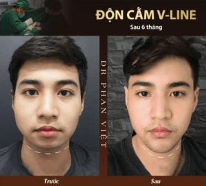 Thẩm mỹ cằm