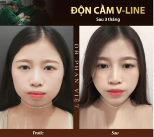 Thẩm mỹ cằm