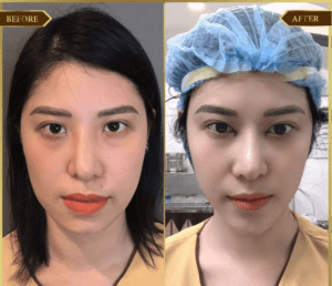 Thẩm mỹ cằm