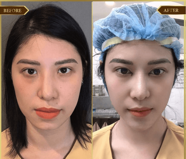 Thẩm mỹ cằm